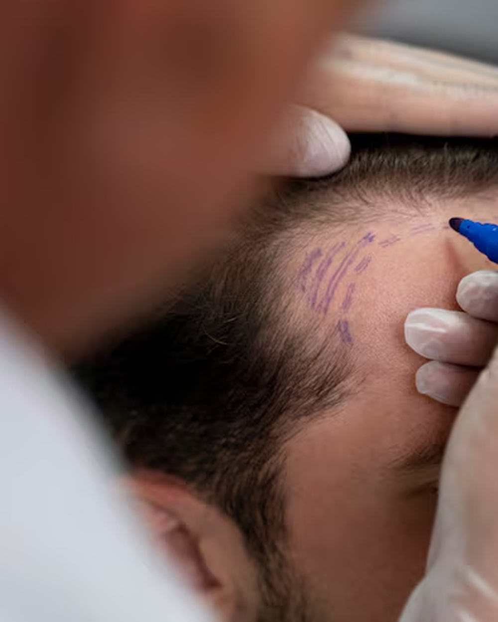 Before scalp micropigmentation: receding hairline and thinning crown