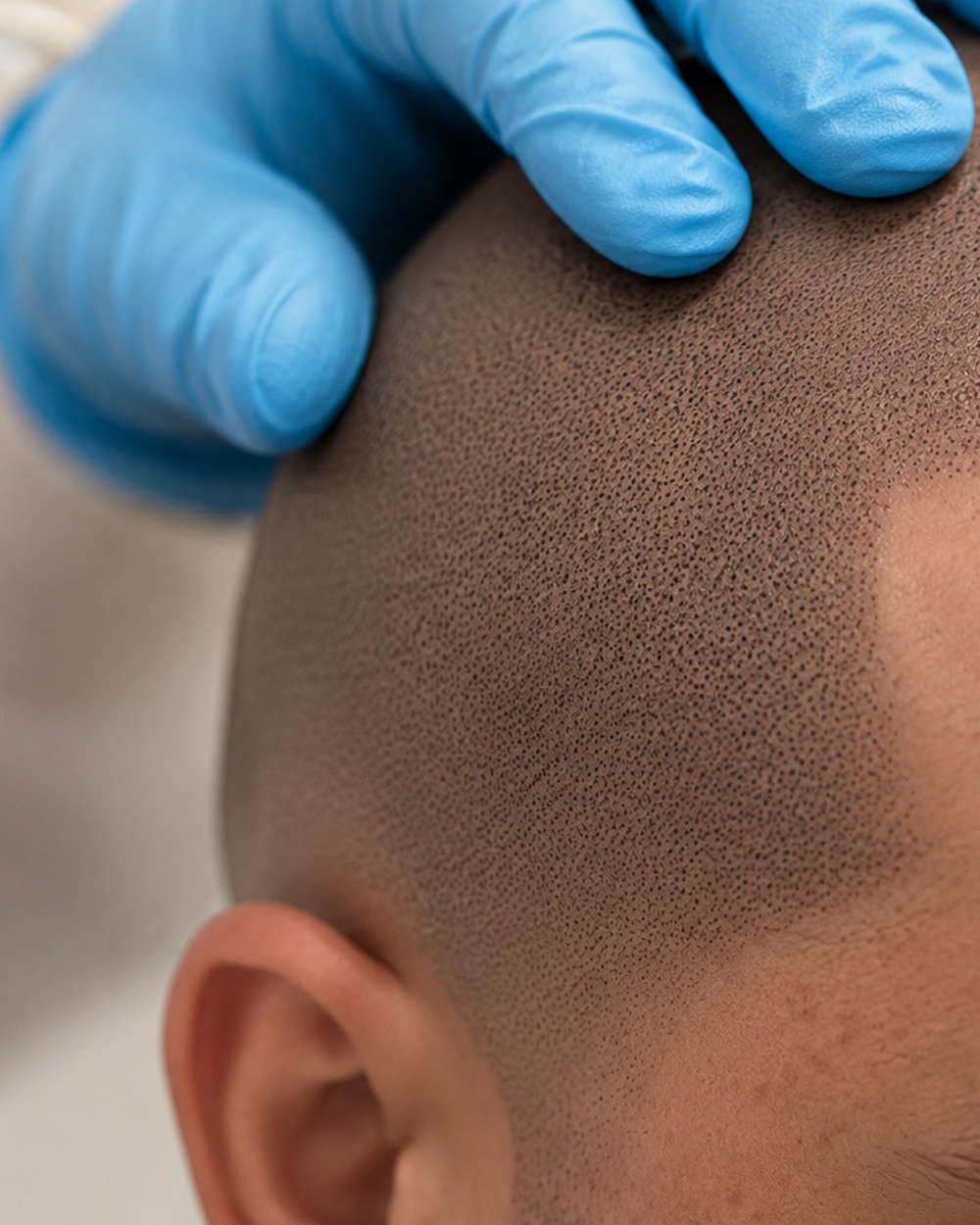 After SMP density work: scalp show-through eliminated