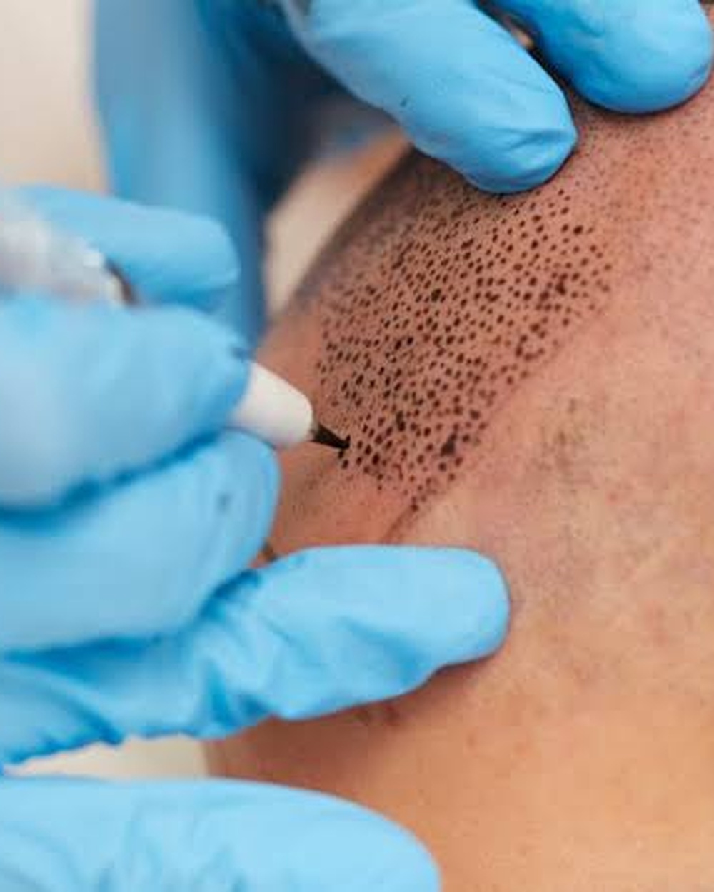 Before SMP density work: visible scalp through thinning hair
