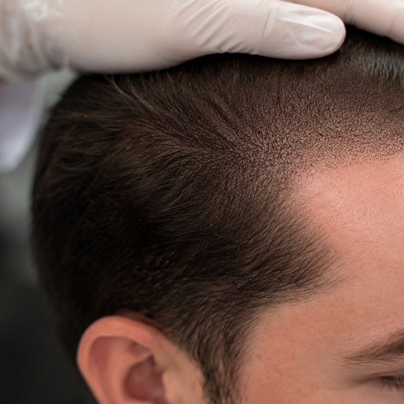 Restored hairline and crown density after scalp micropigmentation