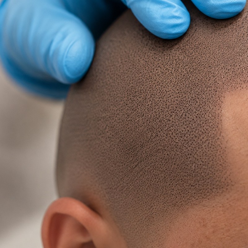 Density scalp micropigmentation result through thinning crown