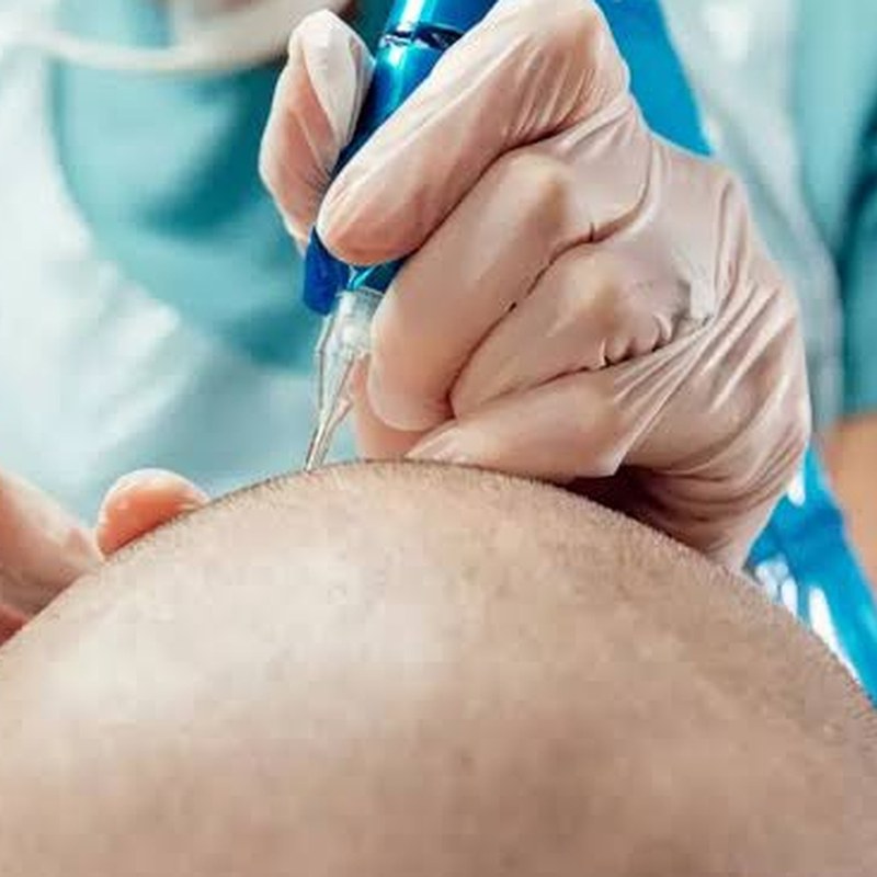 Precision scalp micropigmentation treatment session in progress