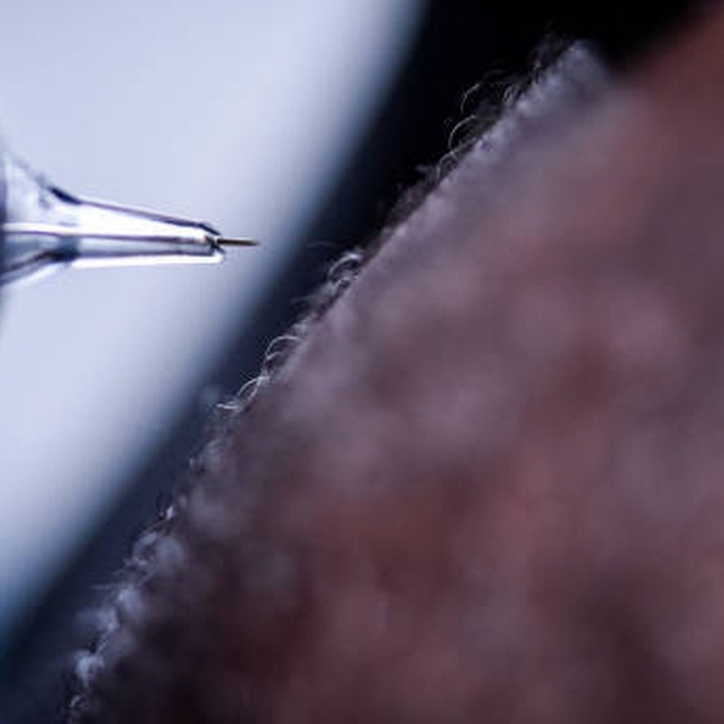 Scalp micropigmentation procedure and follicle pigment application
