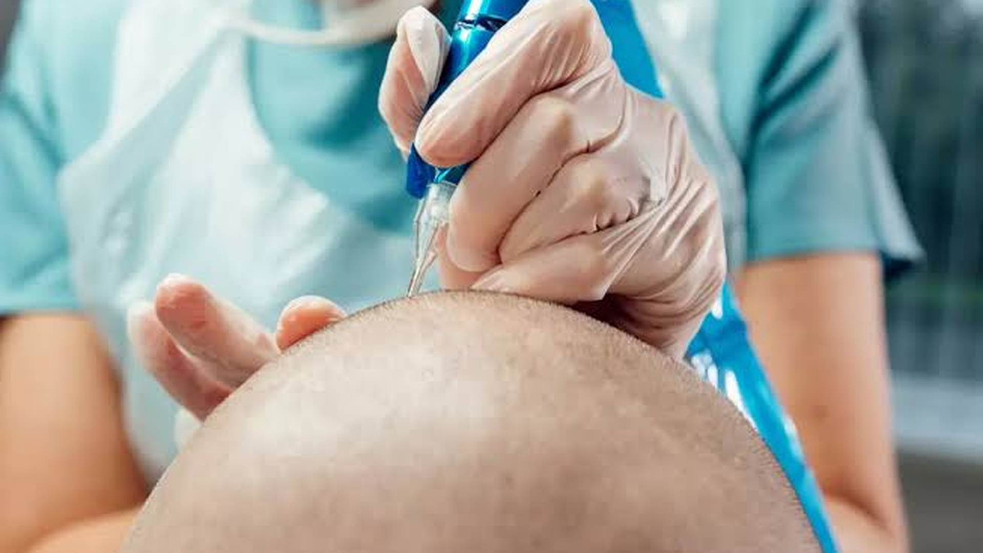 AHNEWME technician placing scalp micropigmentation pigment deposits