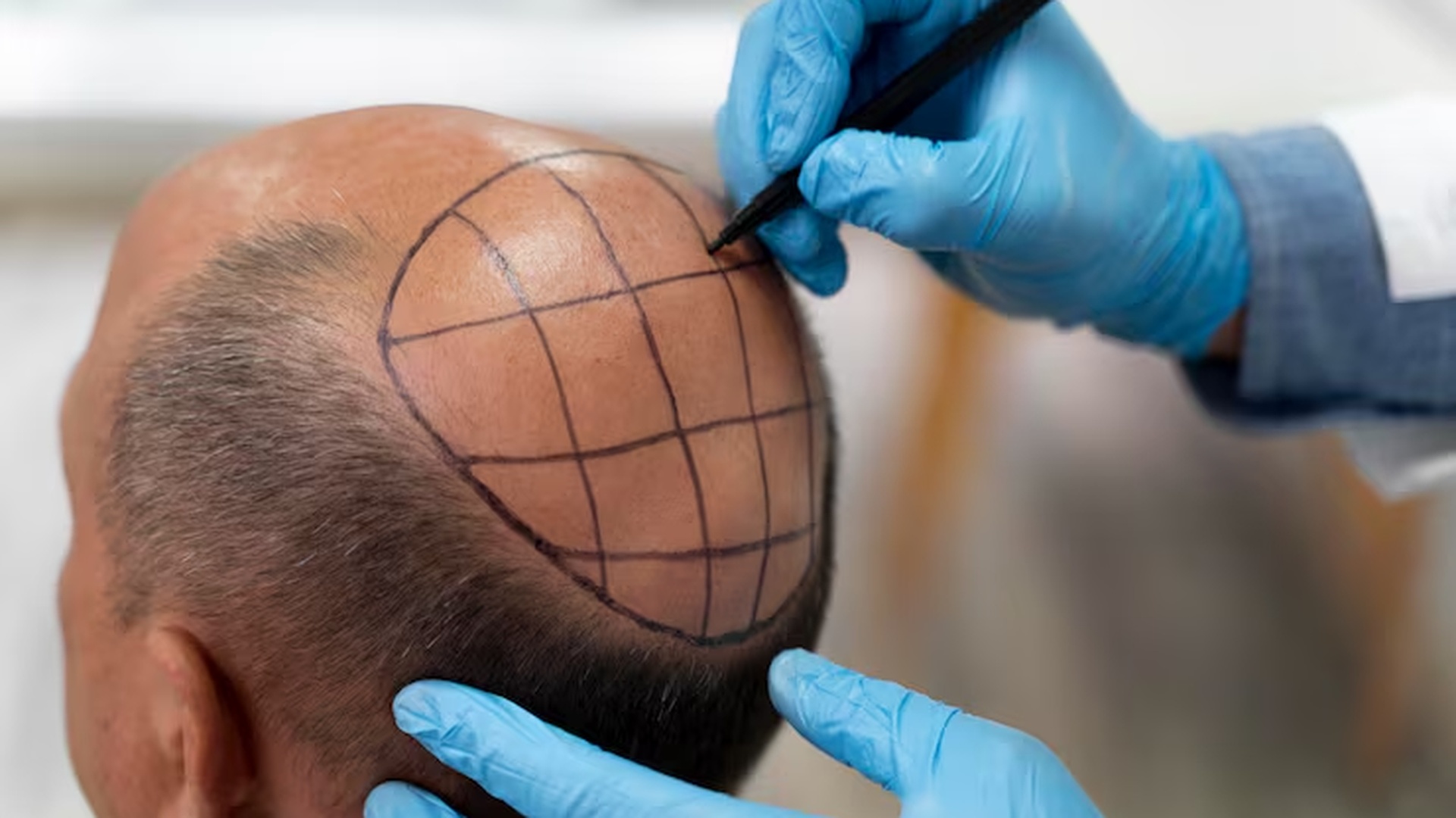 Close-up of a healed scalp micropigmentation result showing natural follicle detail