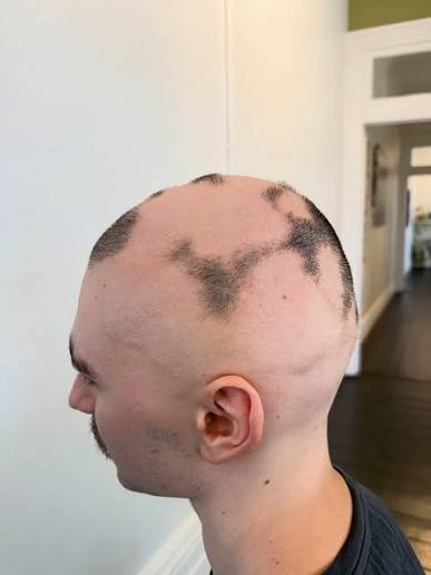 Scalp micropigmentation providing even coverage for an alopecia client