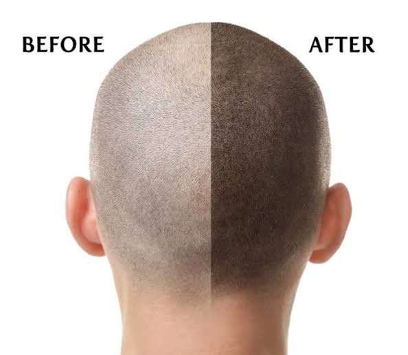 Non-surgical hair addition being fitted and blended at AHNEWME Fredericksburg VA