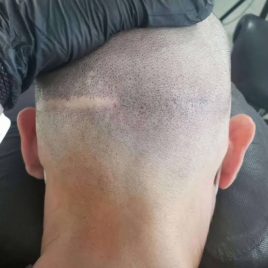 FUT strip scar being camouflaged with scalp micropigmentation pigment