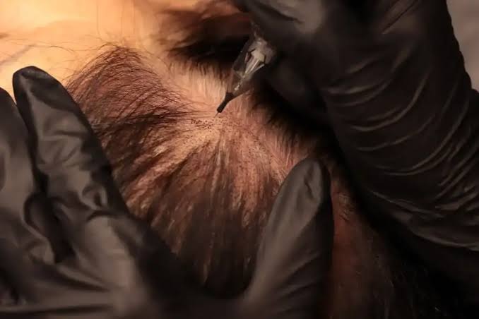 Density scalp micropigmentation applied between existing hairs on a thinning crown
