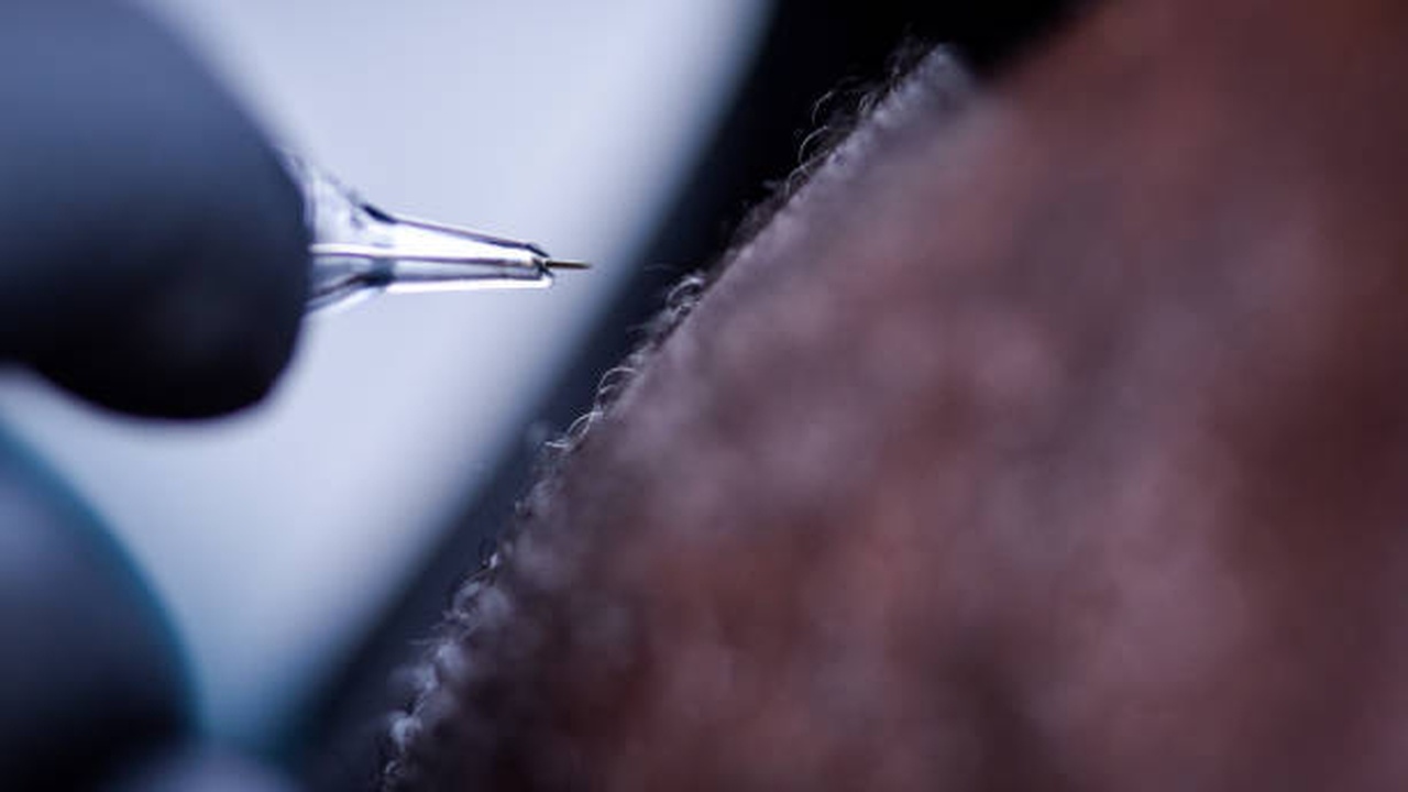 AHNEWME scalp micropigmentation treatment in progress